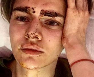 Никита Турчин сообщил, что ему срочно необходима психологическая помощь после избиения